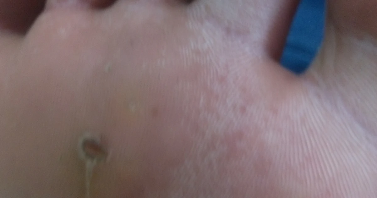 Close-up of a round callus on the sole of an adult foot.