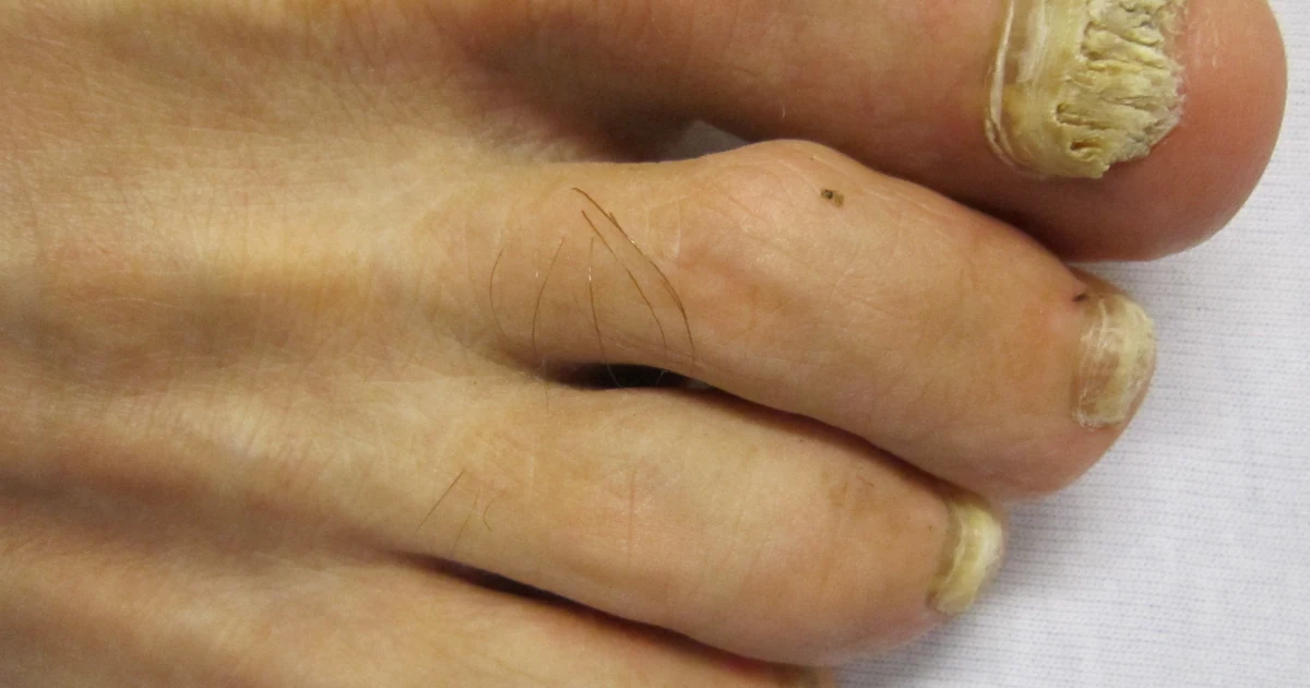 Close-up of thickened and discolored toenails affected by onychomycosis.