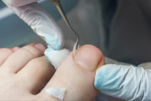 7 Signs You Have an Ingrown Toenail: A Guide From Your Podiatrist in Atlanta