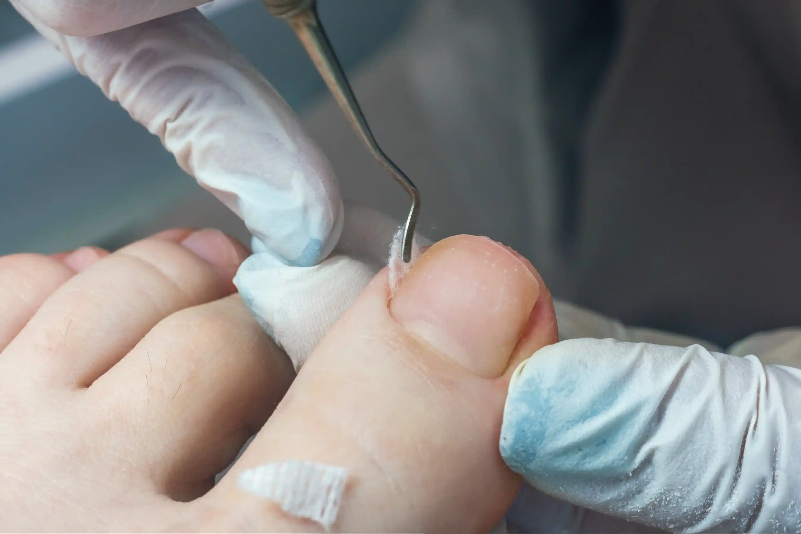 podiatrist doing tamponade to a deformed toenail