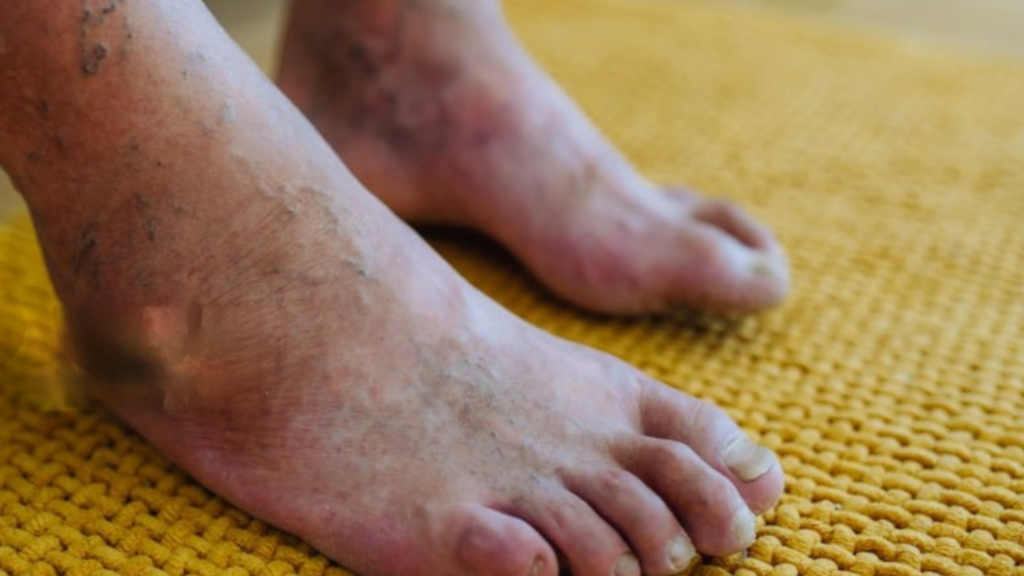 Diabetic Foot Care