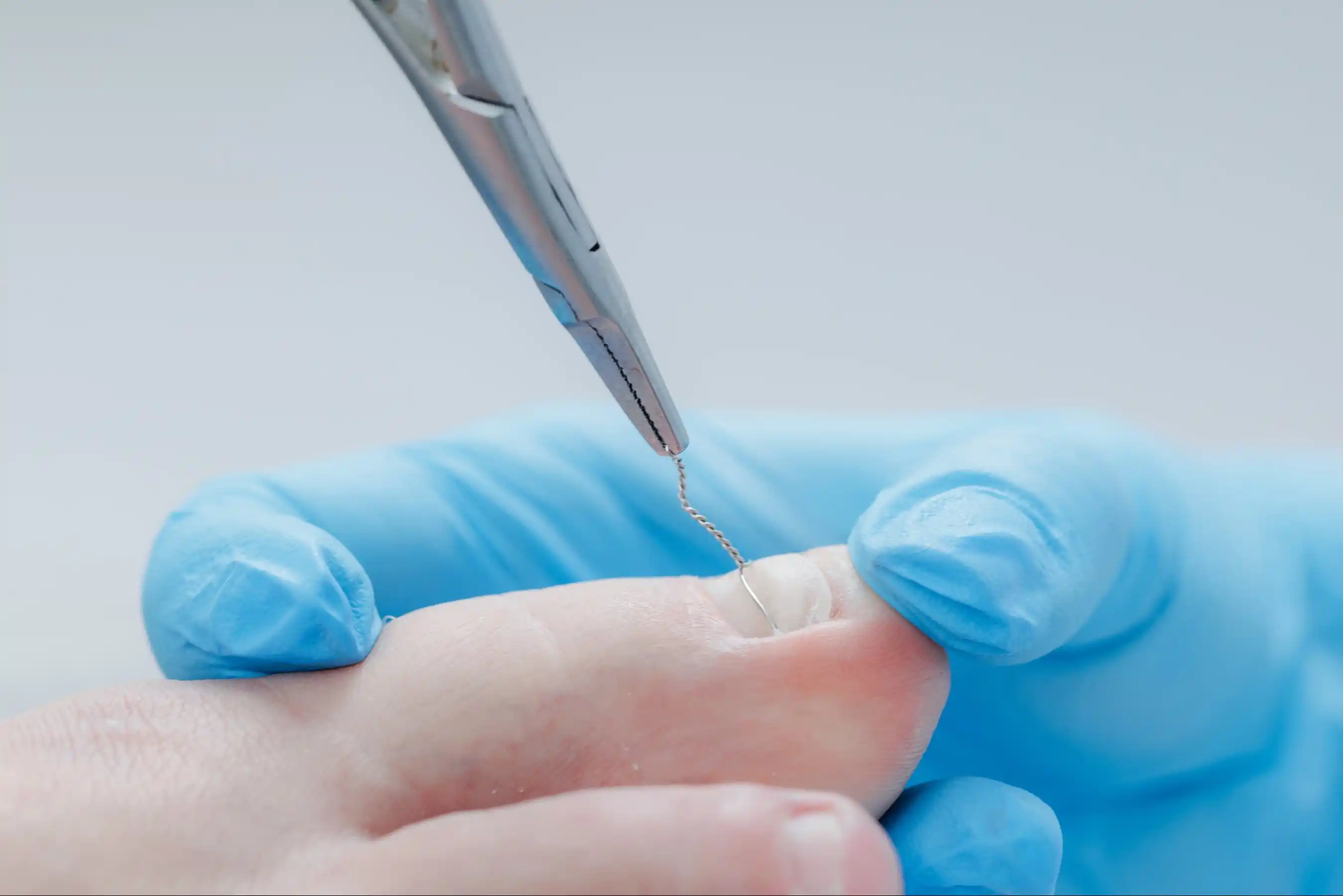 Ingrown toenail treatment with brace application by gloved hand and tool