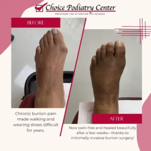 Transform Your Life with Minimally Invasive Bunion Surgery at Choice Podiatry Center
