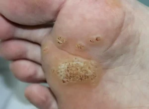 Understanding Plantar Warts: Causes