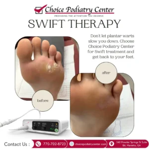 What Are Plantar Warts?