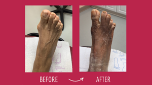Bunion treatment Marietta GA by Dr. Vivian Iwu at Choice Podiatry Center