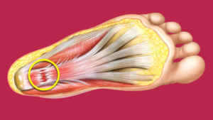 Plantar fascia heel pain diagram showing inflamed tissue